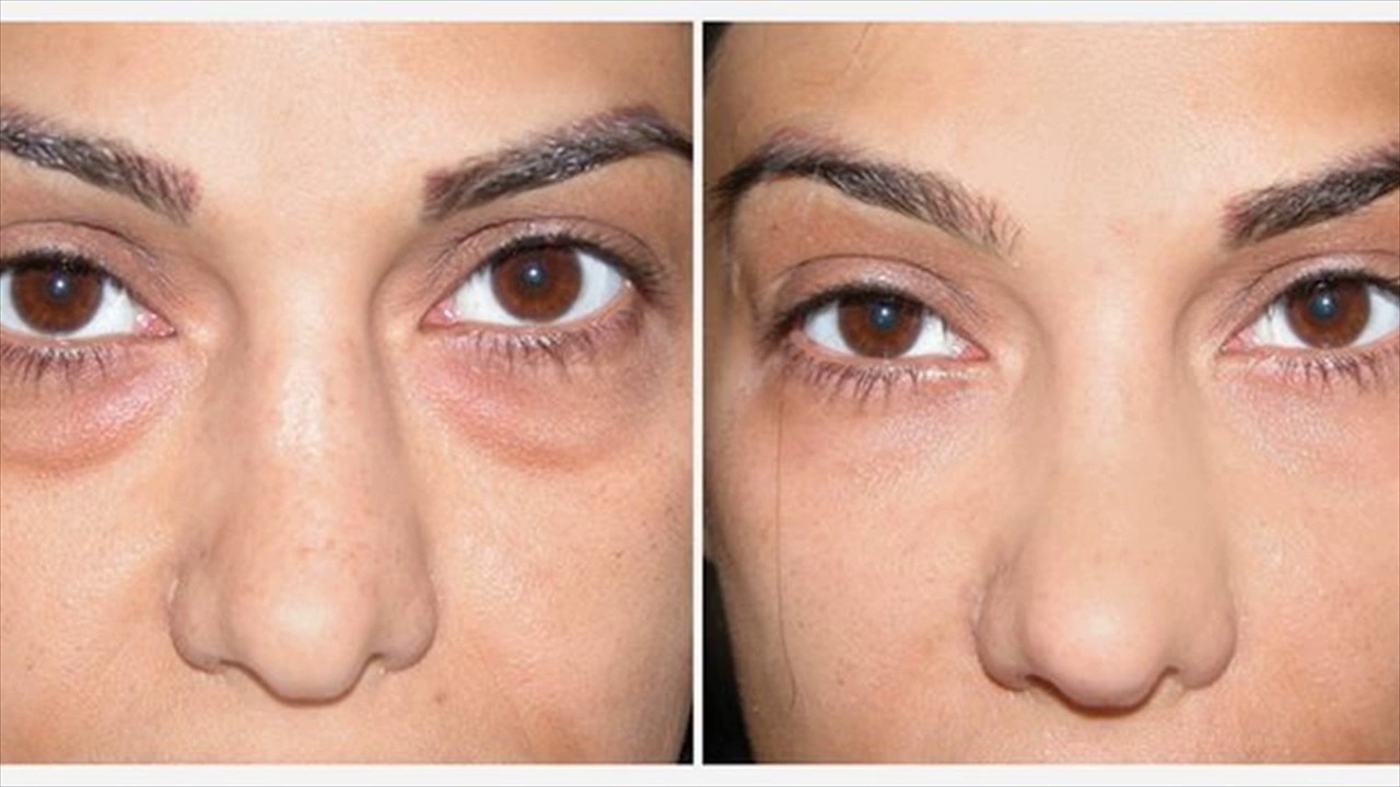 Everything You Need To Know About Under Eye Bags And Dark Circles Surgery Story Hippo
